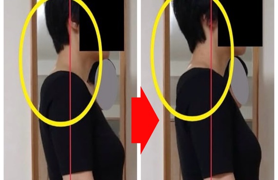 日野市の整体・カイロプラクティック｜重度の肩こりと便秘をファシア（筋膜）から根本改善